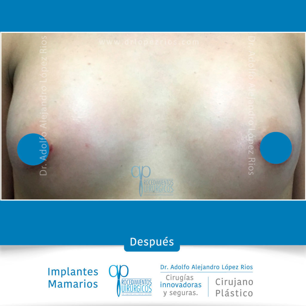 29_nov_post_insta_fb_lateral1_mamoplastia