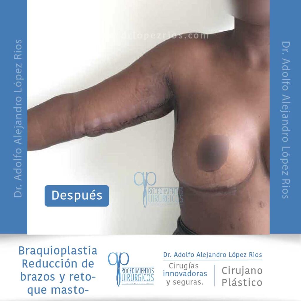 Braquioplastia-02